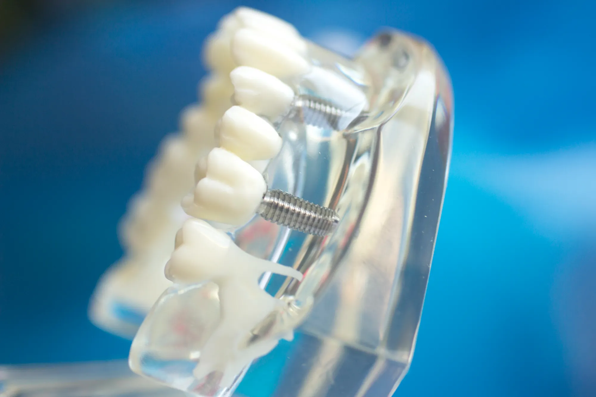 dental implants greensboro nc model