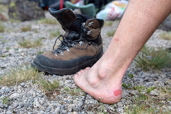 hiker showing blister on heel