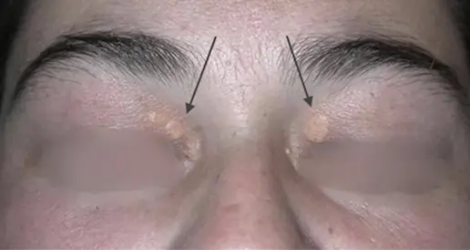 What is Xanthelasma