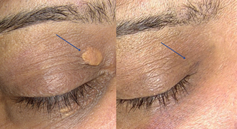 Xanthelasma Removal Before and After
