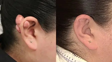 Before and after keloid scar removal treatment in Melbourne at QC Skin Clinic