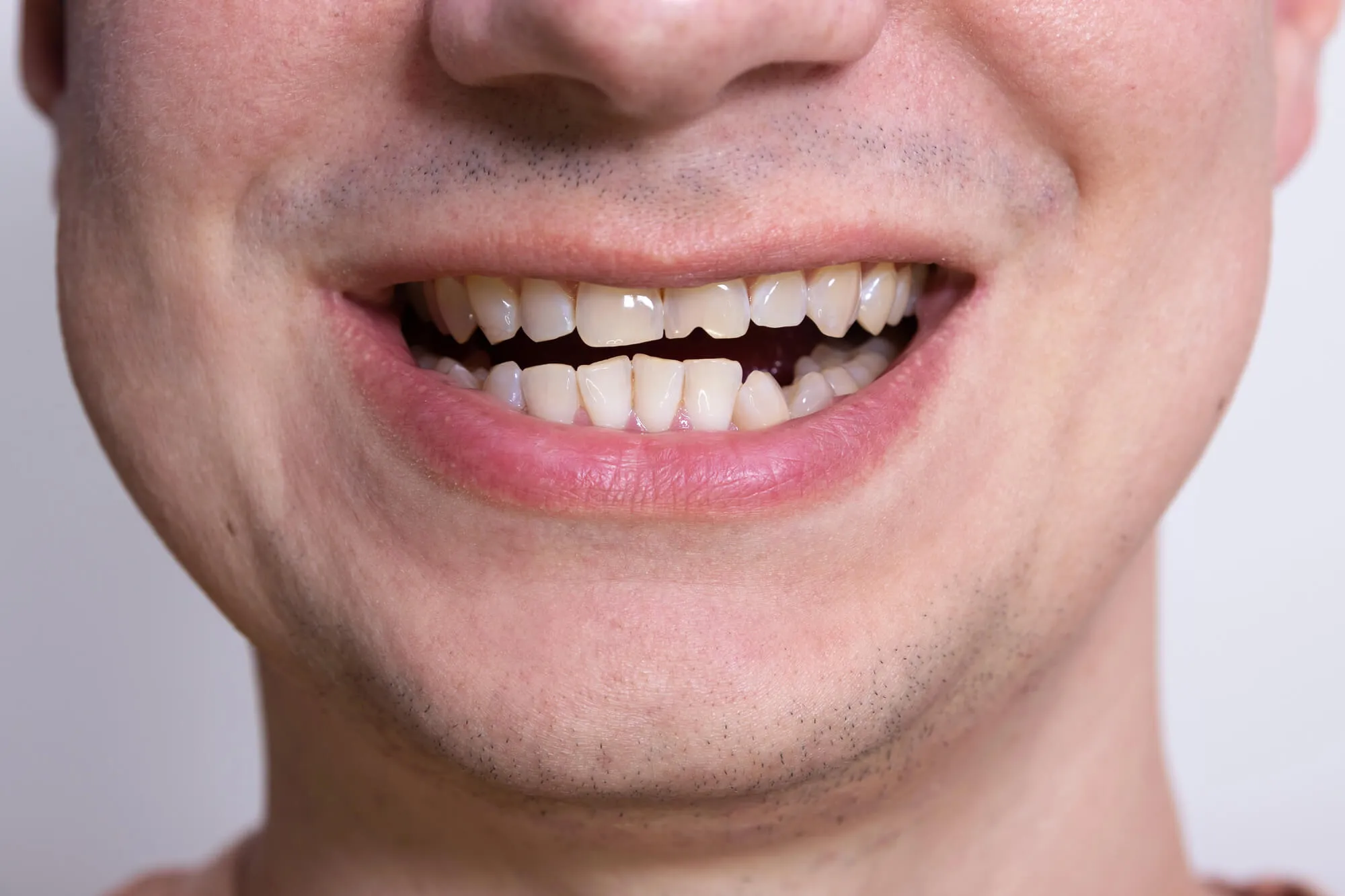 patient needs restorative dentistry boynton beach 2