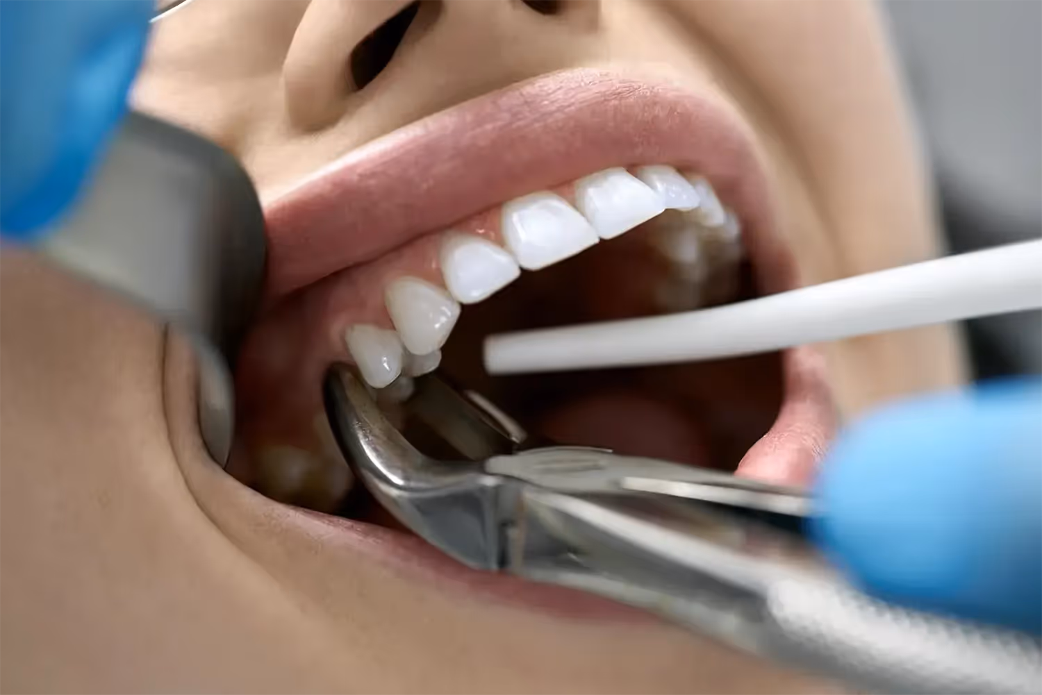 Tooth Extractions in Dothan