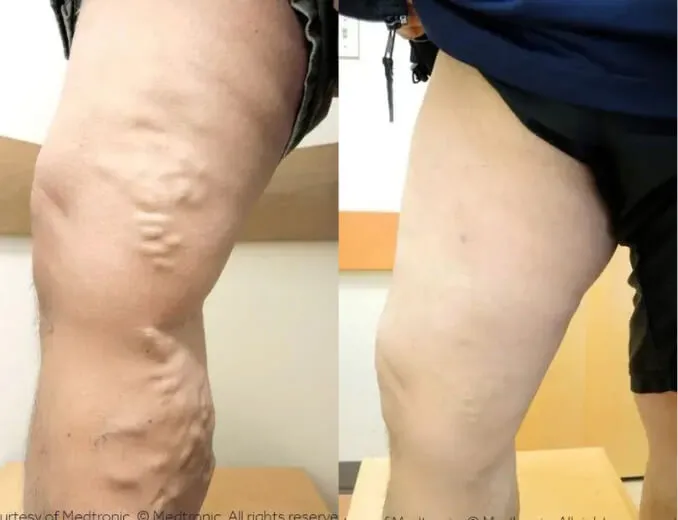 Visible reduction of bulging leg veins after minimally invasive varicose vein treatment for a Pleasanton patient at BASS Vein Center.