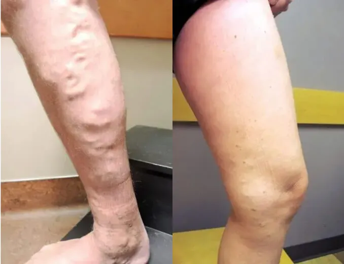 Visible reduction of bulging leg veins after minimally invasive varicose vein treatment for a Pleasanton patient at BASS Vein Center.