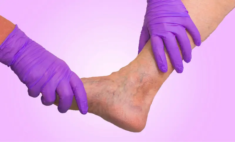 Doctor wearing purple gloves examining a patient’s ankle with visible varicose veins during a vein evaluation at BASS Vein Center.