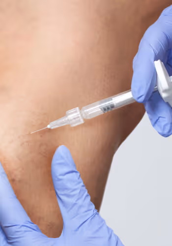 Close-up of a medical professional wearing blue gloves injecting a sclerotherapy needle into spider veins on a person's leg.