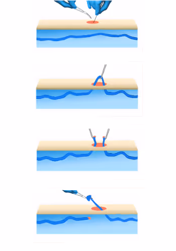 Four-step medical illustration showing ambulatory phlebectomy: making a skin incision, using forceps to pull out a vein segment, extracting the vein, and removing the segment with a tool.