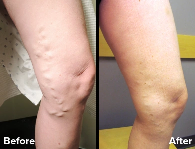 Before and after treatment of bulging varicose veins on the upper thigh showing smoother skin and reduced visible vein prominence.