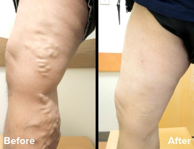 Side view before and after varicose vein treatment demonstrating significant improvement in twisted surface veins along the thigh.
