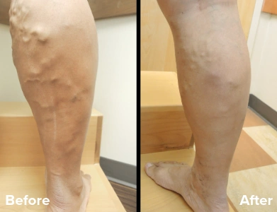 Lower leg before and after vein treatment with reduced varicose veins and improved skin appearance along the calf and ankle.
