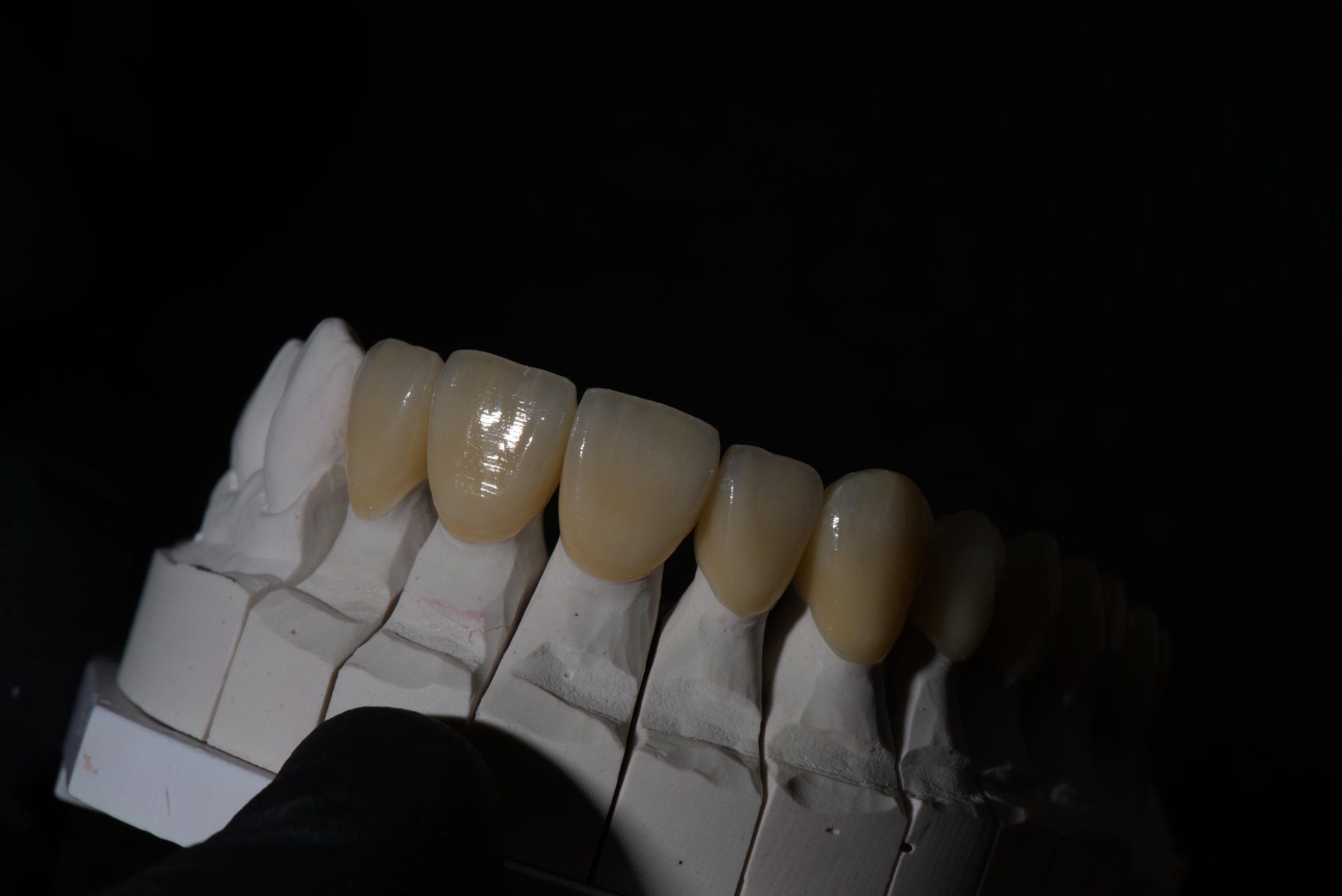 Individuelle Zahnkrone für perfekte Frontzahnästhetik und Smile-Design - präzise Zahntechnik für ein strahlendes Lächeln.