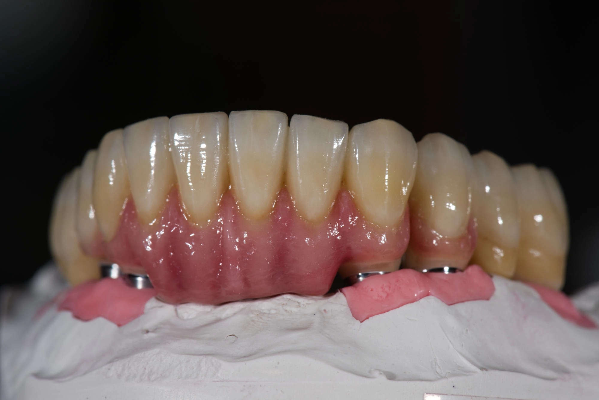 Das Bild zeigt eine Zahntechnisch hergetellte Implantat Unterkiefer Front Brücke mit Gingiva Anteil aus Keramik