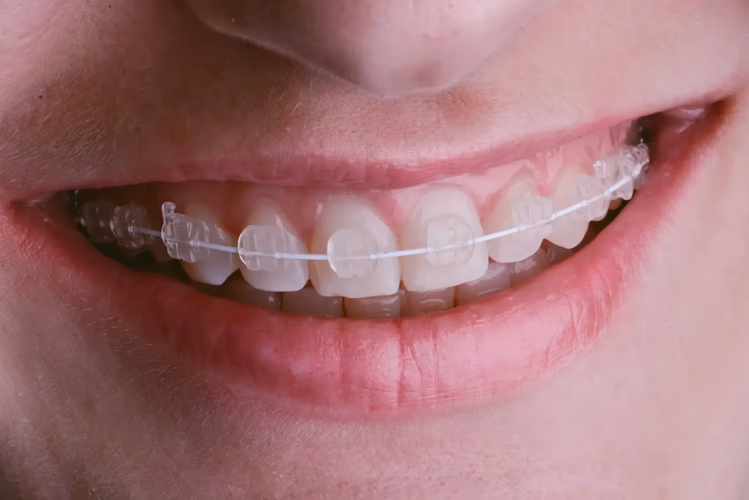 Ceramic Braces in Bozeman