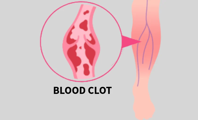 Cartoon illustration of deep vein thrombosis, which is a blood clot in the leg.