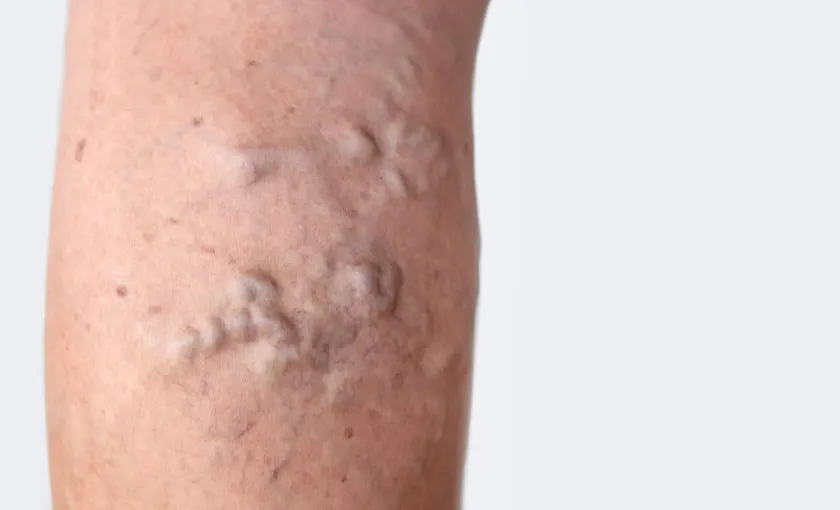 Purple-colored spiraling veins bulging out of the back of a calf.