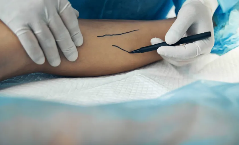 Vein specialist marking varicose veins on a patient’s leg before ambulatory phlebectomy at BASS Vein Center.