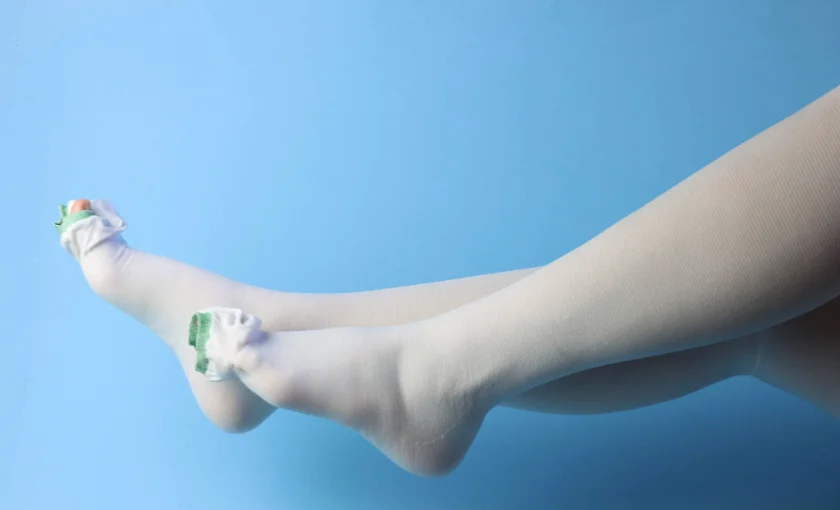 Compression stockings used as conservative treatment for varicose veins at BASS Vein Center.