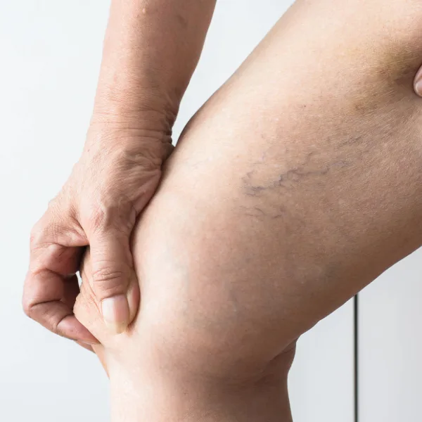 Spider veins on a patient's inner thigh.