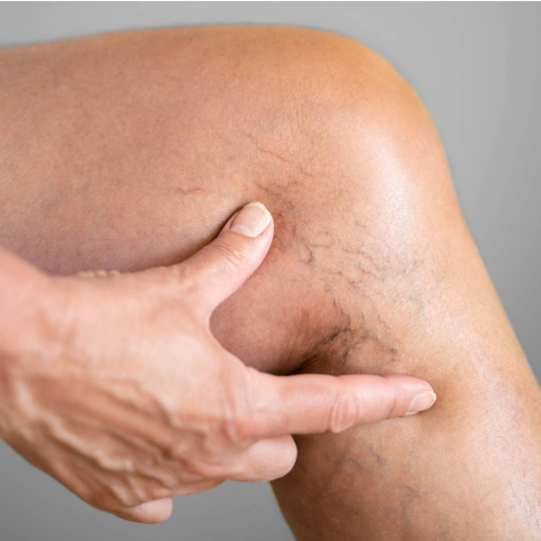 Legs with early varicose veins.