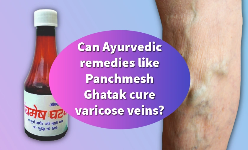 Ayurvedic herbal medicine alongside medical image of varicose veins, comparing natural remedies to medical treatment.