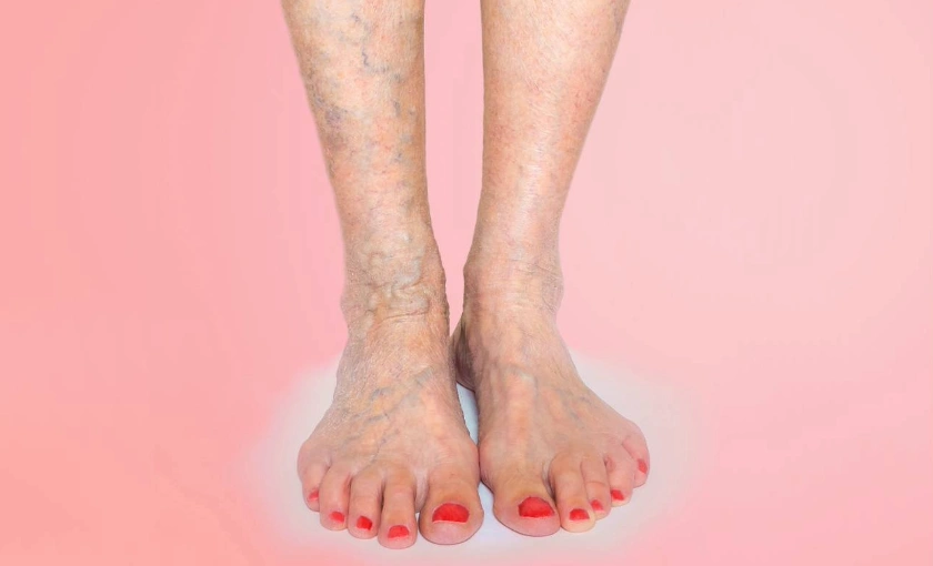 Older woman's legs with leg swelling and skin discoloration, common signs of chronic venous insufficiency.