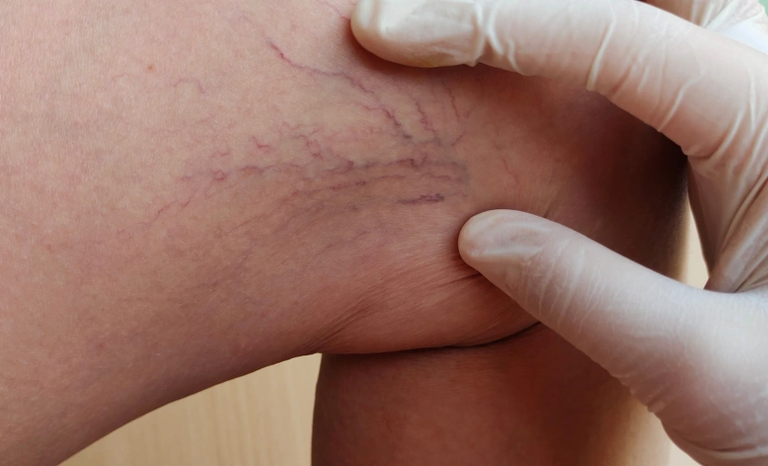 Varicose veins on the leg showing bulging, twisted veins associated with venous insufficiency