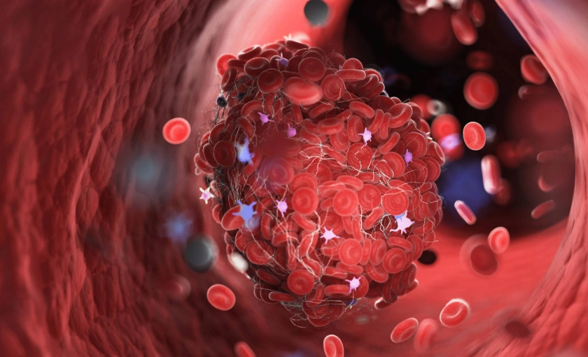Medical illustration of a small blood clot in a superficial vein of the leg (superficial thrombophlebitis)