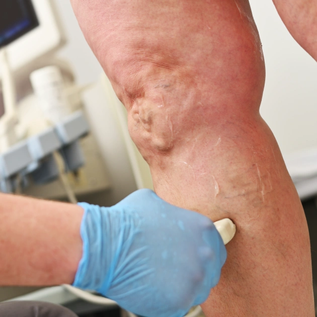 Vascular specialist using Doppler ultrasound to evaluate blood flow in the leg arteries of a patient with Peripheral Arterial Disease (PAD)
