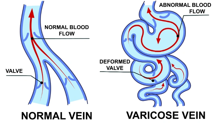Comparison of blood flow in a normal and varicose vein