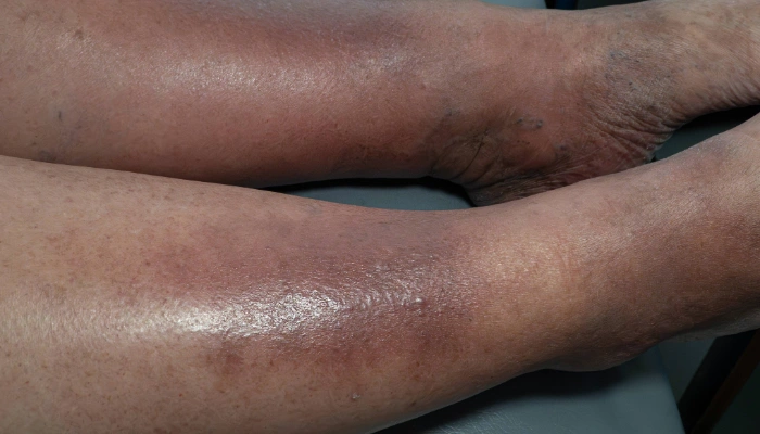 Legs with skin discoloration caused by venous stasis