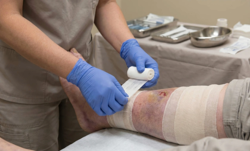 Clinician dressing a venous stasis ulcer on a patient’s swollen lower leg