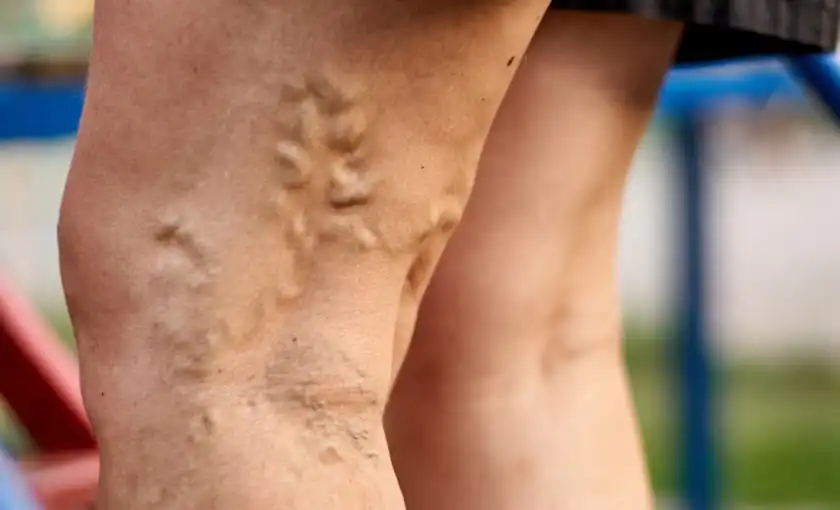 Visible, bulging varicose veins on the outer thigh