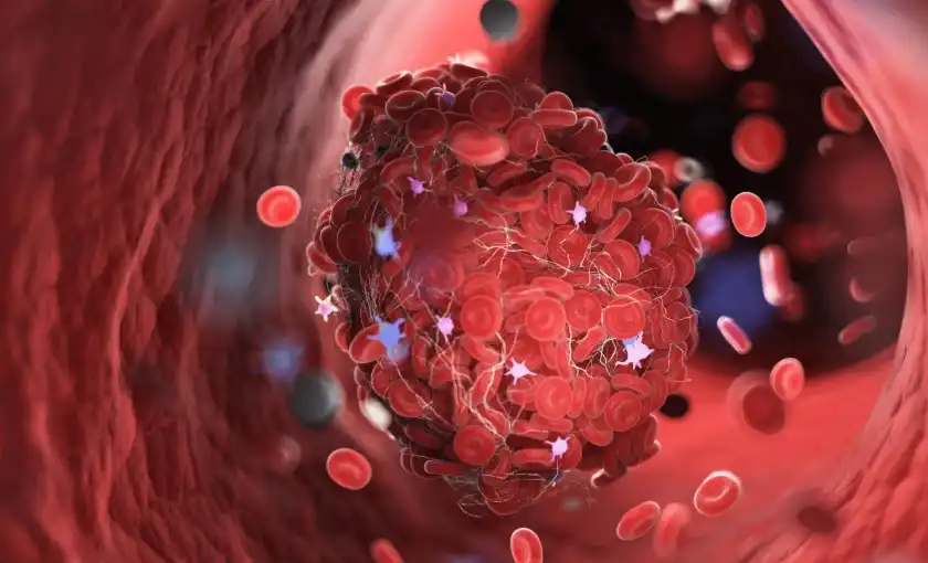 Medical illustration of a small blood clot in a superficial vein of the leg (superficial thrombophlebitis)