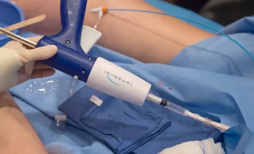 VenaSeal catheter device delivering medical adhesive during a varicose vein treatment