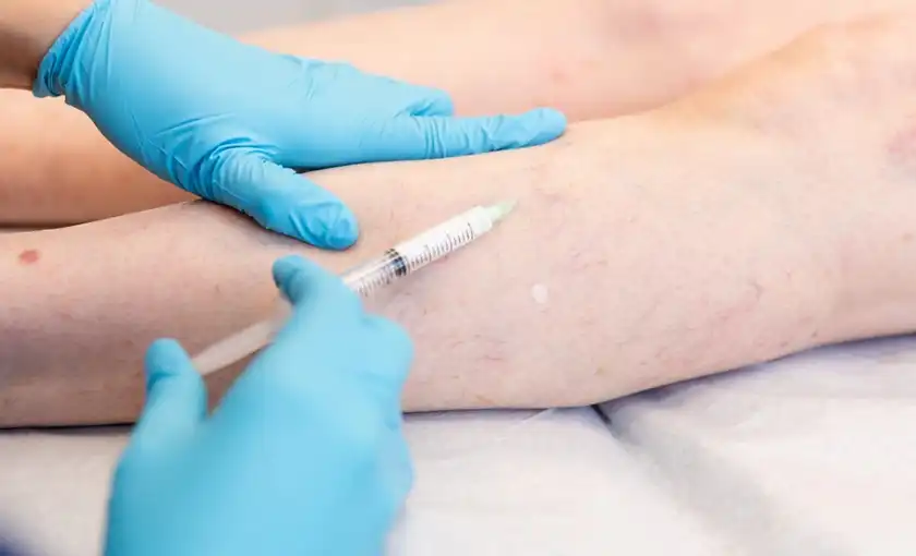A doctor injecting sclerotherapy solution into a leg with spider veins