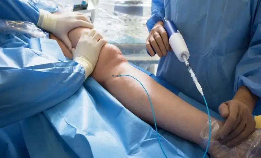 Venaseal catheter device being used to seal off a varicose vein with medical grade adhesive