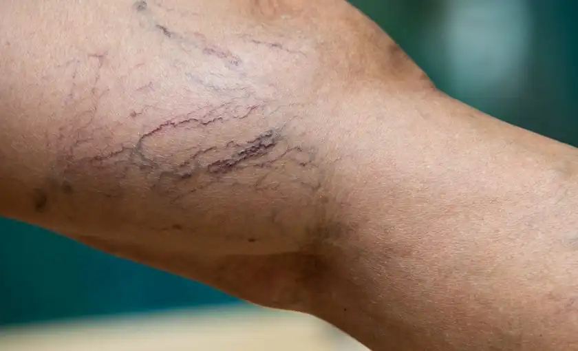 Spider veins on a thigh