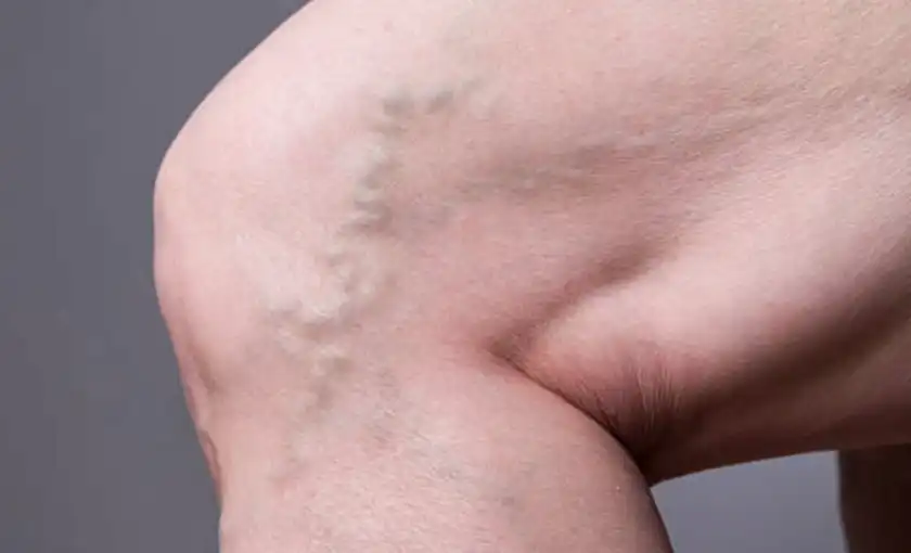 A vein that is bulging and twisting near the knee