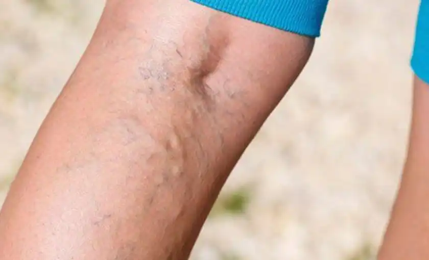 Bulging vein on the backside of a calf near the knee bend