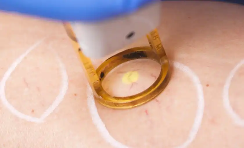 A superficial laser treatment for small spider veins close to the surface