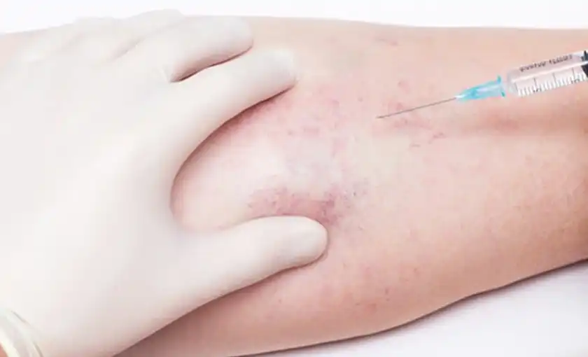 A gloved doctor about to inject a calf with solution to remove spider veins