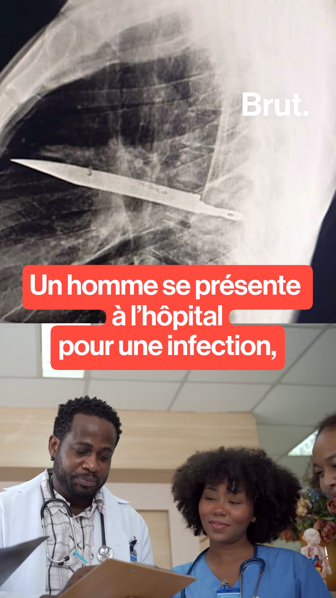 a-l-hopital-il-decouvre-qu-il-a-une-lame-de-couteau-dans-la-poitrine-depuis-8-ans