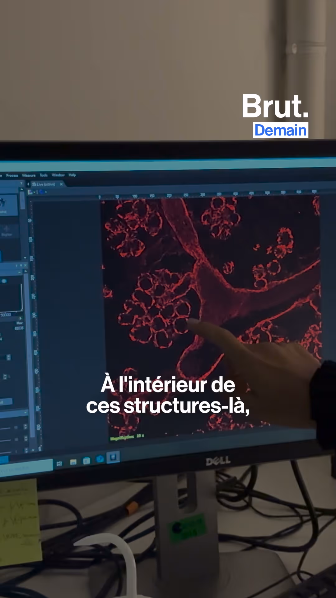 BRUT. DEMAIN — Elles étudient le cancer du sein post-partum.