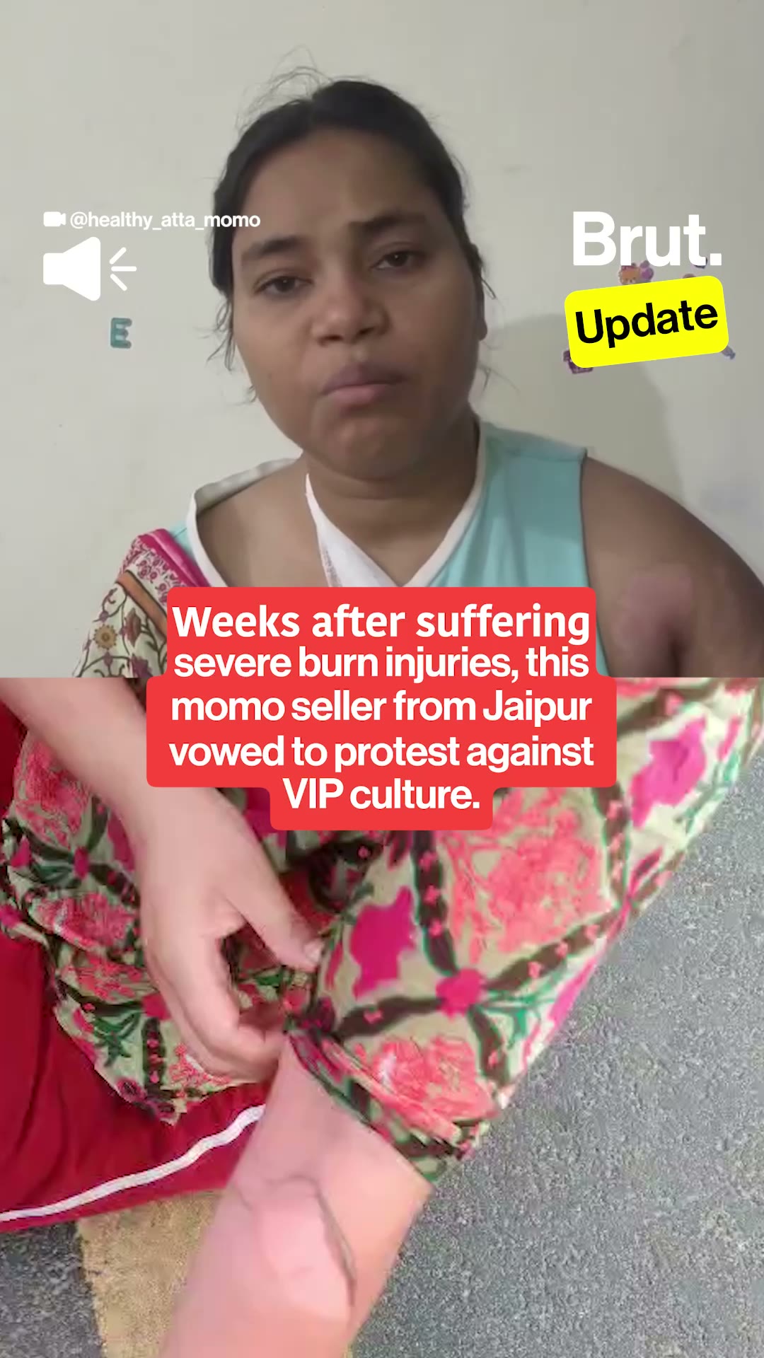Jaipur momo seller, who suffered burn injuries, vows to protest against VIP culture