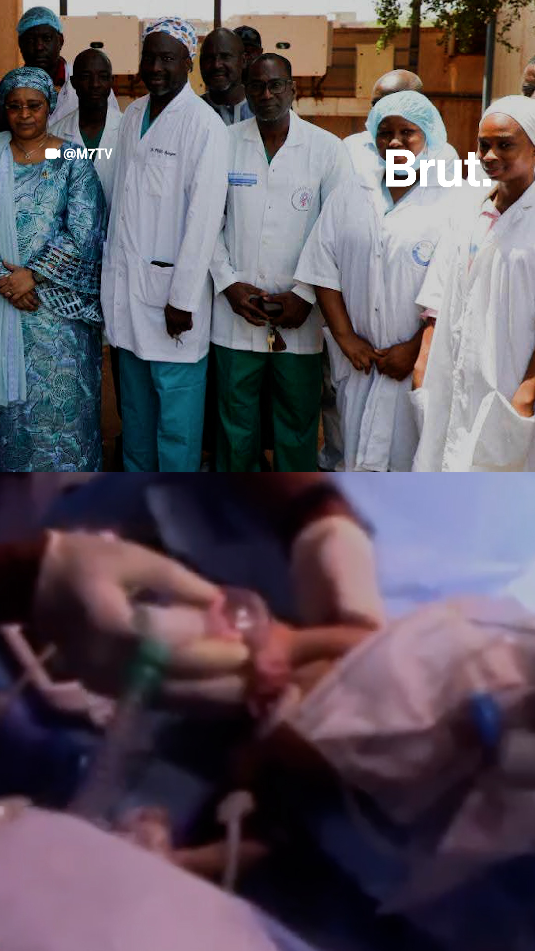 mali-des-medecins-reussissent-pour-la-premiere-fois-la-separation-de-deux-bebes-siamois