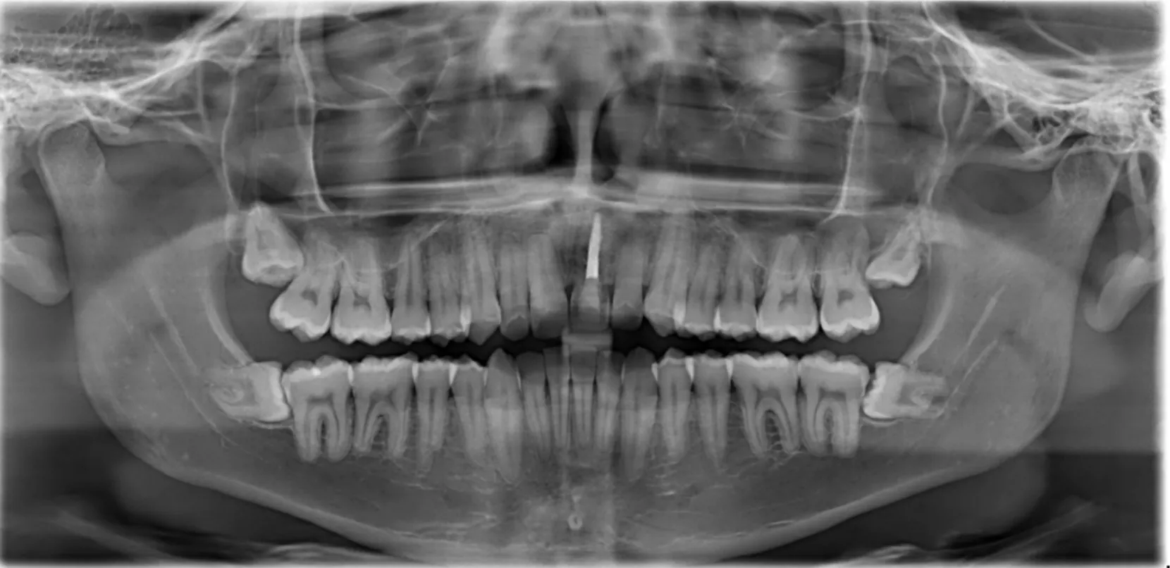 OPG X-ray