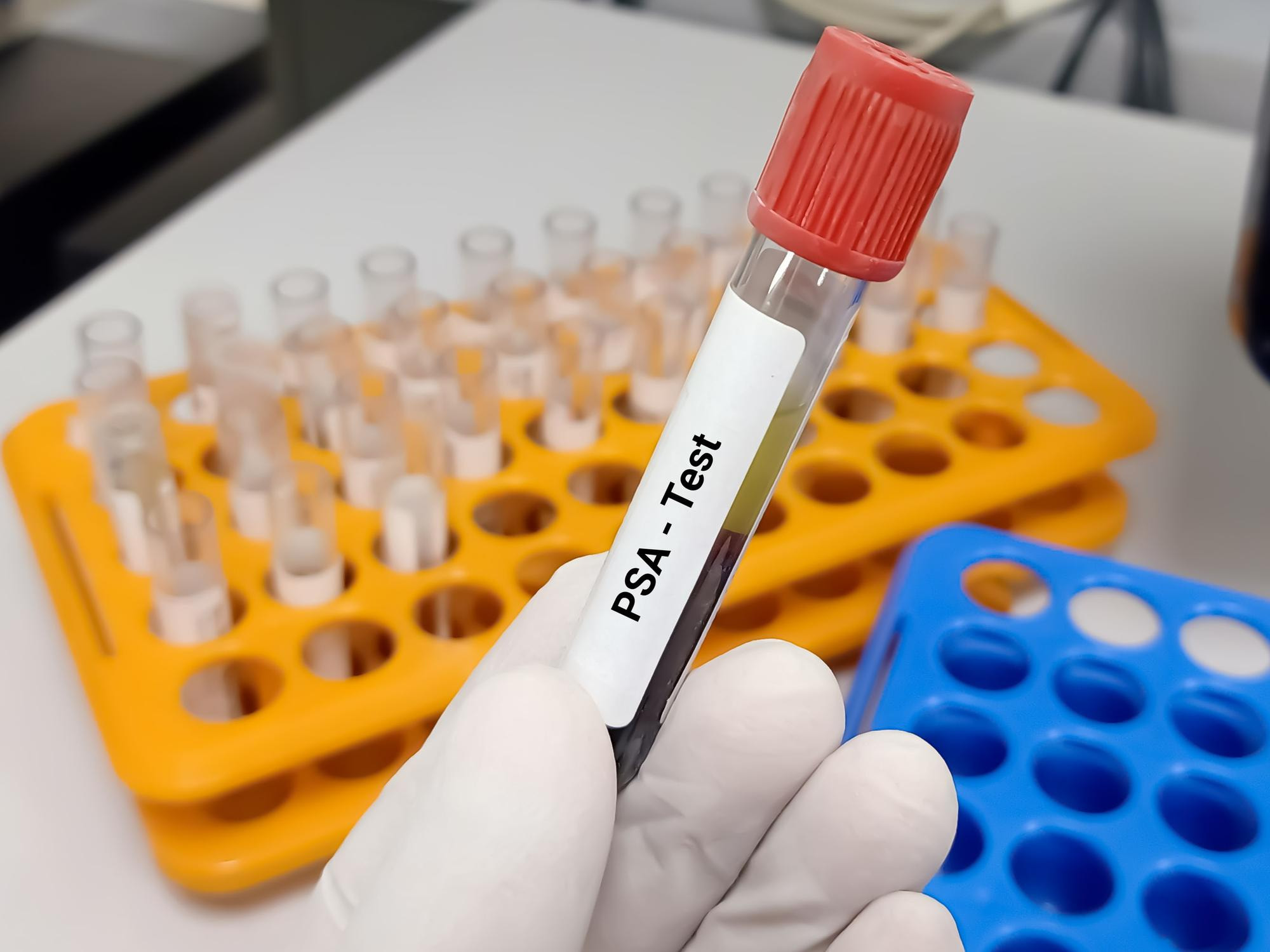 What Causes a Raised PSA?