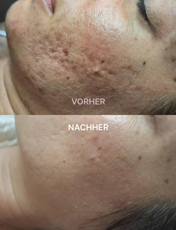 Gesicht nah, vorher mit Aknenarben, nachher mit deutlich glatterer Haut und reduzierten Narben.