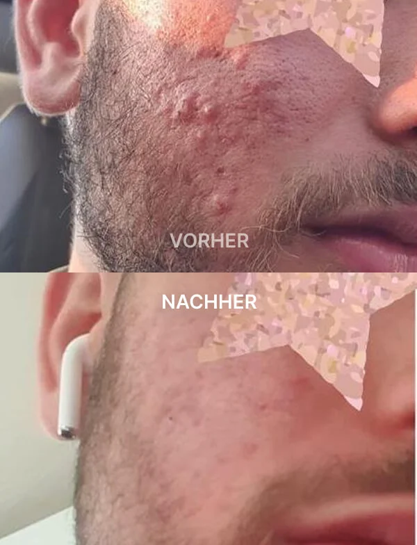 Vorher-Nachher-Vergleich eines Gesichts mit Akne vor und nach Behandlung, klarere Haut im Nachher-Bild.